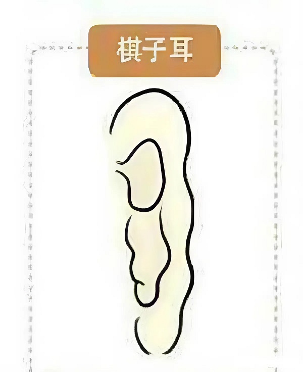 Tìm hiểu tai quân cờ là gì